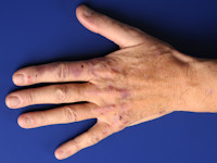 Porphyria cutanea tarda