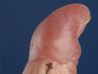 Porphyria cutanea tarda