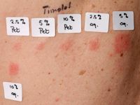 Positieve plakproef timolol