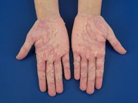 Vervelling na streptokokken infectie