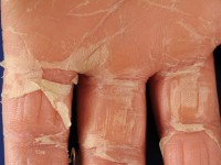 Vervelling na een onbekende infectie