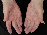 Vervelling na streptokokken infectie