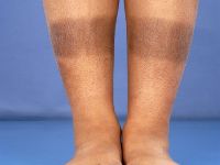 Post-inflammatory hyperpigmentation