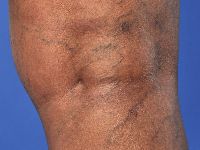 Post-inflammatory hyperpigmentation