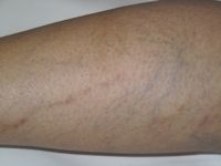 Post-inflammatory hyperpigmentation