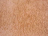 Post-inflammatoire hyperpigmentatie