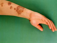 Post-inflammatory hyperpigmentation