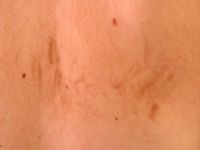 Post-inflammatoire hyperpigmentatie