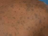 Postinflammatoire hyperpigmentatie na lichen-planus