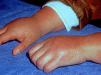 Posttraumatische reflex dystrofie, Sudeck atrofie