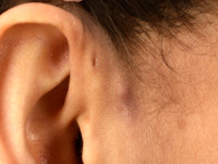 Pre-auriculaire cyste