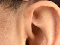 Pre-auriculaire cyste