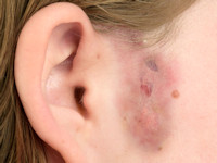 Pre-auriculaire cyste