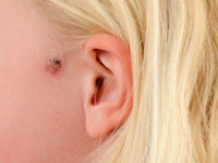 Pre-auriculaire cyste