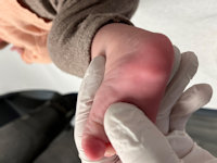 Precalcaneal congenital fibrolipomatous hamartoma