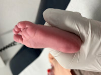 Precalcaneal congenital fibrolipomatous hamartoma