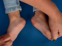 Precalcaneal congenital fibrolipomatous hamartoma