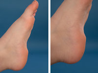 Precalcaneal congenital fibrolipomatous hamartoma
