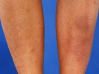 Pretibiaal myxoedeem