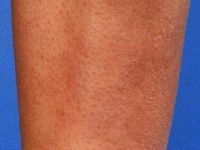 Pretibiaal myxoedeem