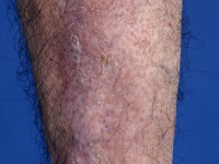 Pretibiaal myxoedeem