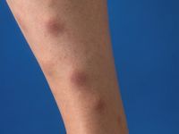 Pretibiaal myxoedeem