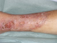 Pretibiaal myxoedeem