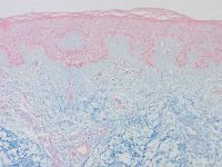 Pretibiaal myxoedeem