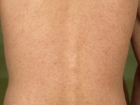 Primair HIV exantheem