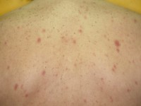 Primair HIV exantheem