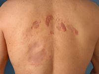 Primair cutaan grootcellig B-cellymfoom