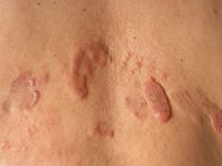 Primair cutaan grootcellig B-cellymfoom