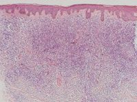 Primair cutaan grootcellig B-cellymfoom
