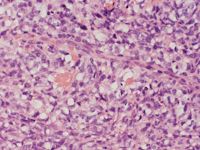 Primair cutaan grootcellig B-cellymfoom