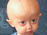 Progeria, vroegtijdige veroudering