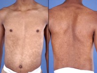 Progressive macular hypomelanosis