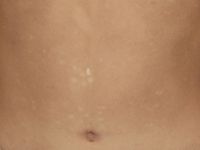 Progressive macular hypomelanosis