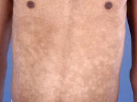 Progressieve maculaire hypomelanosis