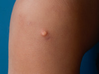 Progressieve ossale heteroplasie 