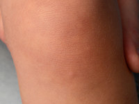 Progressieve ossale heteroplasie 