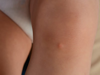 Progressieve ossale heteroplasie 