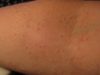 Prurigo acute, acute itching bumps