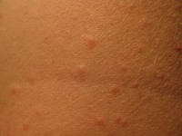 Prurigo acute, acute itching bumps