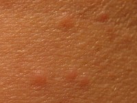 Prurigo acute, acute itching bumps