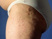 Prurigo of pregnancy, prurigo gestationis