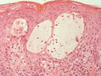 Histologie prurigo pigmentosa