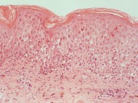 Histologie prurigo pigmentosa