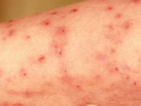 Pruritus senilis met veel krabeffecten