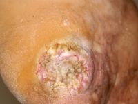 Pseudo-epitheliomateuze