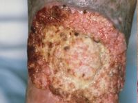 Pseudo-epitheliomateuze